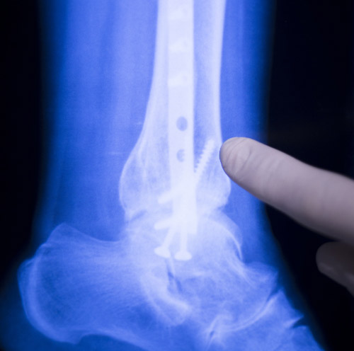 ricostruzione legamenti caviglia con protesi