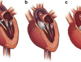 sapien valvola cardiaca