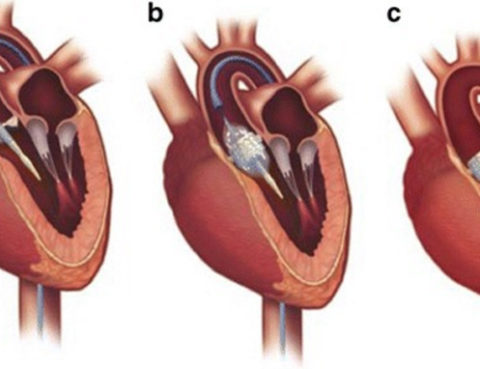 sapien valvola cardiaca