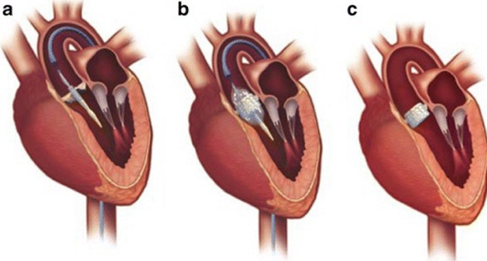 sapien valvola cardiaca